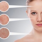Cách trị mụn đầu đen hiệu quả nhất