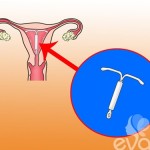 Cách đặt vòng tránh thai